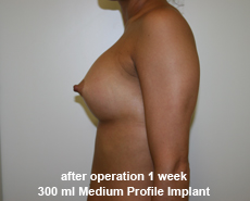 plastic-surgery-breast-augmentation